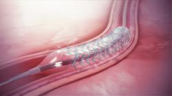 Stent je umiestnený do tepny nafúknutím balónika na katétri. Kredit: Scientific Animation. https://www.scientificanimations.com/  Creative Commons Attribution-Share Alike 4.0 International