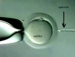 ICSI – intracytoplasmic sperm injection