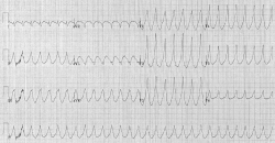 EKG záznam komorovej tachykardie. Kredit:  Karthik Sheka, M.D. , CC BY-SA 2.5.