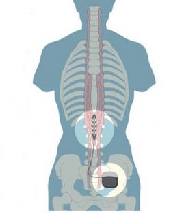 Epidural electrical stimulation. Kredit IBS Hospitals.