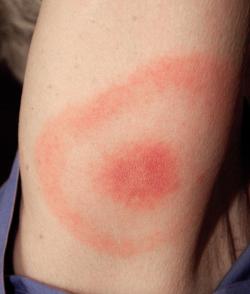 Typické začervenanie – erythema migrans pri boréliovej infekcii kože. Kredit: Hannah Garrison - en:User:Jongarrison CC BY-SA 2.5 Typické začervenanie – erythema migrans pri boréliovej infekcii kože. Kredit: Hannah Garrison - en:User:Jongarrison CC BY-SA 2.5
