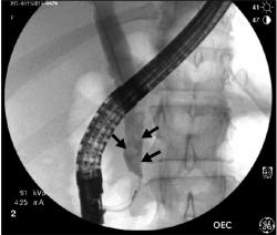 Zobrazenie kamienkov v žlčovode (svetlejšie útvary, označené šípkami) na rentgenovej snímke, zhotovenej počas ERCP vyšetrenia. Výrazný pruh je obraz gastroskopu, menej výrazný tmavý tieň je žlčovod, naplnený kontrastnou látkou. Kredit: David Troendle MD