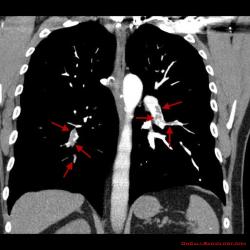 Jednoznačný CT nález pri pľúcnej embólii - tmavé výpadky v svetlej kontrastnej náplni pľúcnych artérii.