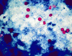 Nález Cryptosporidium parvum v preparáte zo stolice pacienta. Kredit: Dr Tomas Jelinek, Department of Infectious Diseases and Tropical Medicine, Germany