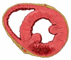 Infarkt - poškození srdeční stěny ischemií. Buňky odumírají, sval se stává nefunkčním. (Kredit: Patrick J. Lynch, medical illustrator, Wikipedia)