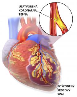 Svalovina v oblasti nedokrvenia pri srdcovom infarkte je poškodená alebo udomiera následkom nedostatku kyslíka.  (Kredit: Blausen Medical Communications/Wikipedia/CC-A 3.0)