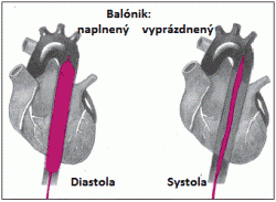 IABP - činnosť balónikovej pumpy v aorte: v diastole (medzi sťahmi srdca) je balónik naplnený héliom a krv vytlačená z aorty; v systole (pri sťahu srdca) je balónik vyprázdnený a aorta sa plní krvou zo srdca. (Kredit: FDA)
