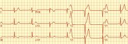 EKG obraz predného infarktu myokardu. Elektrokardiografia znamenala prvý prielom v diagnostike infarktu.