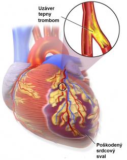 Na počiatku infarktu je vznik krvnej zrazeniny - trombóza koronárnej tepny.