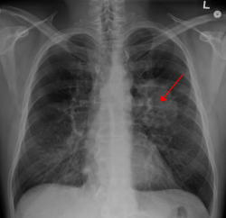 Nádor pľúc, ktorý je zobrazený na klasickej rentgenovej snímke pľúc, sa už pravdepodobne nepodarí vyliečiť. Kredit: James Heilman, MD, Wikimedia Commons, CC BY-SA 3.0.