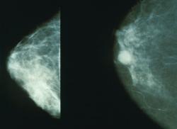 Snímek z mamografu. Levá polovina normální stav, vpravo nádor. Mamografické vyšetření je rentgenové vyšetření. Kredit: National Cancer Institute.   