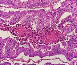 Mikroskopický obraz kolorektálního karcinomu. Kredit: Mikael Häggström, Wikipedia, CC0 1.0