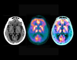 Ve vzorcích lidské mozkové tkáně od osob s Alzheimerovou chorobou i bez ní bylo objeveno více než tisíc dosud přehlížených „mikroproteinů“. Desítky z těchto mikroproteinů vykazovaly změněnou expresi u osob s Alzheimerovou chorobou, což je zjištění, které by mohlo otevřít cestu k odhalení nových mechanismů stárnutí a neurodegenerace. Atlas mikroproteinů lidské frontální kůry u Alzheimerovy choroby v datech zde. (Kredit: Brendan Miller a kol. 2026) https://pubmed.ncbi.nlm.nih.gov/42736449/
 (Kredit: Foto: Zephyr/SPL, Nature).