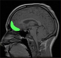 Dysfunkce orbitofrontální kůry může být jednou z příčin poruch sociálního chování, včetně psychopatie Kredit: PaulWicks English Wikipedia, volné dílo