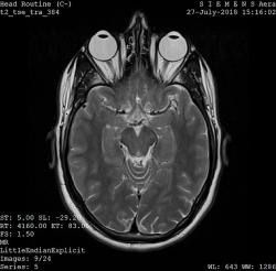Mozek na MRI. Kredit: Ptrump16 / Wikimedia Commons.