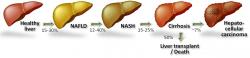 Zkratkou NAFLD (Non-Alcoholic Fatty Liver Disease) se v anglosaské literatuře  označuje souborně jaterní steatóza, steatohepatitida, fibróza i cirhóza, jejichž původcem není alkohol. V rozvinutých zemích postihuje již 30 % populace. U 12 – 40 % s tímto syndromem se vyvine nevratné poškození jater a zhruba u čtvrtiny z nich propuká cirhóza s vyhlídkou na transplantaci jater a rizika zhoubného nádoru. Myším krátkodobý pobyt ve stavu bez tíže přivodil řadu známek počínajícího onemocnění jater, které jsou neklamným signálem pro  lidskou formu nealkoholického poškození jater.  Pramen: World Gastroenterology Organisation Global Guidelines, Kredit: Almed Pharmaceuticals