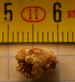 Močový kámen o velikosti 8 mm. Zhruba 80 % konkrementů je z vápenatých solí. Obvykle vytvářejí kalcium oxalátové, či méně obvykle kalcium fosfátové konkrementy.  Autor: Robert R. Wal, Wikipedia    http://en.wikipedia.org/wiki/Kidney_stone