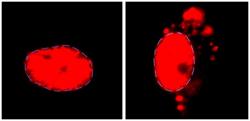 Za normálních okolností se „U2-snRNP“ (červeně) nachází v jádru motorických neuronů (vlevo). U nemocných ALS a též u postižených frontotemporální demencí (FTD), se hromadí vně jádra jejich neuronů. Příčinou je v článku pospaná mutace. Kredit: Reed Lab / Harvard Medical School
