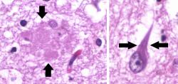 Amyloidní plaky (vlevo) a neurofibrilární klubko (vpravo) v histopatologickém vzorku mozkové tkáně postižené Alzheimerovou nemocí Kredit Mikael Häggström, Wikipedia, Public Domain CC0 1.0
