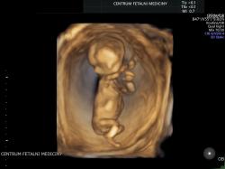 Sérii fotografií s videozáznamem nenarozeného miminka pořízenou „klasickým ultrazvukem“ mnohde poskytnou i za tisícovku. Kredit Fakultní nemocnice Olomouc.