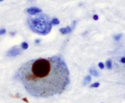 Alfa-synuclein lze imunochemickým barvením zviditelnit. U parkinsoniků jsou jeho hnědé shluky v mozkových neuronech v oblasti Substantia nigra zřetelně vidět. Z doby, kdy se netušilo co znamenají, se jim i dnes říká „Lewyho tělíska“. Kredit: Wikipedia