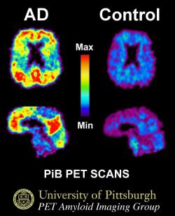 Obsah amyloidu, zobrazený PET vyšetrením mozgu – vľavo pozitívny, vpravo normálny nález. Kredit: University of Pittsburg