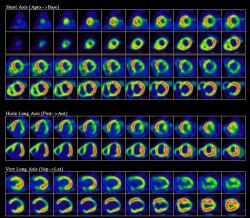 Posúdenie viability myokardu pomocou SPECT  (Single-proton emmision computed tomography): získané obrázky poskytujú dosť málo detailov. Kredit: Heart Institute, University od Ottawa.  https://www.ottawaheart.ca/test-procedure/pet-viability-imaging