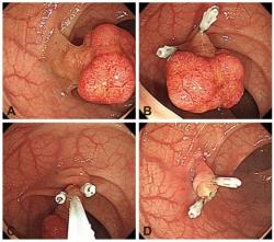Kolonoskopické odstránenie polypu po zaškrtení jeho stopky svorkami - bez krvácania po výkone. Kredit: Boo SJ, et al.,Clin Endosc (2012)