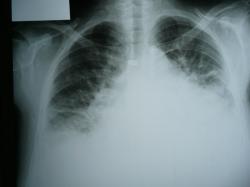 Rentgenový obraz pľúc pacienta s ťažkým srdcovým zlyhaním - srdce je rozšírené a dolná časť pľúc je presiaknutá tekutinou (biele splývajúce škvrny na snímku). Kredit: Nevit Dilmen, Wikipedia, CC BY-SA 3.0