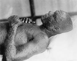 Pravé neštovice stále číhají ve stínech. Kredit: Otis Historical Archives Nat'l Museum of Health & Medicine.