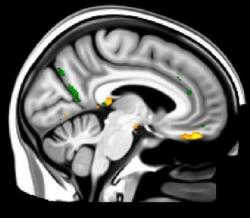 Jeden z analytických MRI snímků s označenými oblastmi pozorovatelných změn Kredit: Douaud, G. et al. SARS-CoV-2 is associated with changes in brain structure in UK Biobank. Nature (2022).