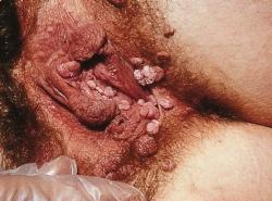 Prejavy infekcie HPV na genitáliach - výrastky condylomata acuminata. (Kredit: SOA-AIDS Amsterdam, Wikipedia , CC BY-SA 3.0)