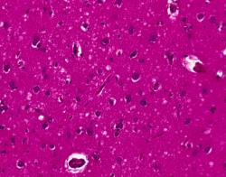 Mozková tkáň nemocného chorobou CJD. Na řezu je vidět velké množství světlejších lokalit. Jsou to ostrůvky, kde celé okrsky nervových buněk již odumřely. (Kredit: DrdoubleB, Wikipedia)