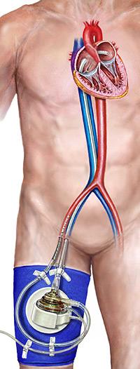 pVAD - zapojenie prístroja TandemHeart: krv je kanylou odoberaná do pumpy z ľavej predsiene srdca a čerpaná do jednej alebo oboch stehenných tepien. (Kredit: TandemHeart, pVAD illustration CardiacAssist, Inc.)