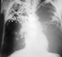 Rentgenový snímek plíce člověka s tuberkulózou. V současné době je u nás očkování proti tuberkulóze povinné (a hrazené pojišťovnou) pouze u vysoce rizikových dětí. Kredit: Wikipedia, volné dílo.