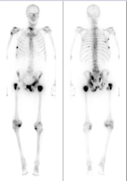 Scintigraficky zobrazené metastázy pokročilého karcinómu do kostí (tmavé škvrny). Tu už ide o život. Kredit:  Apolino, Wikipedia, CC BY-SA 4.0.