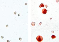 Vlevo: Snímek zdravých makrofágů. Vpravo: Makrofágům s vadným genem se nedaří štěpit lipidy. Červená barvička vázající se na lipidy zviditelnila, jak invalidní makrofágy hromaděním lipidů v cytoplazmě nezdravě bobtnají. Kredit: AG Leutz, MDC.