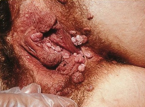 Prejavy infekcie HPV na genitáliach - výrastky condylomata acuminata. (Kredit: SOA-AIDS Amsterdam, Wikipedia , CC BY-SA 3.0)