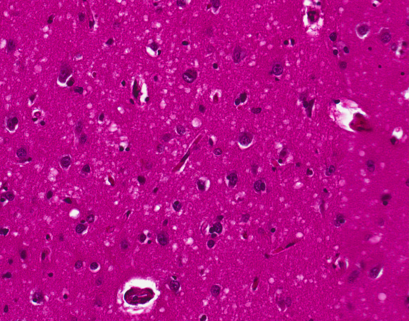 MozkovĂˇ tkĂˇĹ? nemocnĂ©ho chorobou CJD. Na Ĺ™ezu je vidÄ›t velkĂ© mnoĹľstvĂ­ svÄ›tlejĹˇĂ­ch lokalit. Jsou to ostrĹŻvky, kde celĂ© okrsky nervovĂ˝ch bunÄ›k jiĹľ odumĹ™ely. (Kredit: DrdoubleB, Wikipedia)