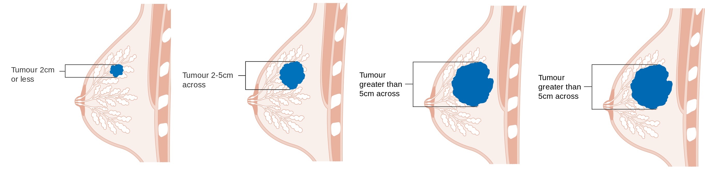 Diagram znázorňující stádia nádoru T1,T2,T3, T4. (Kredit: Cancer Research UK, CRUK, Zdroj: Wikimedia).