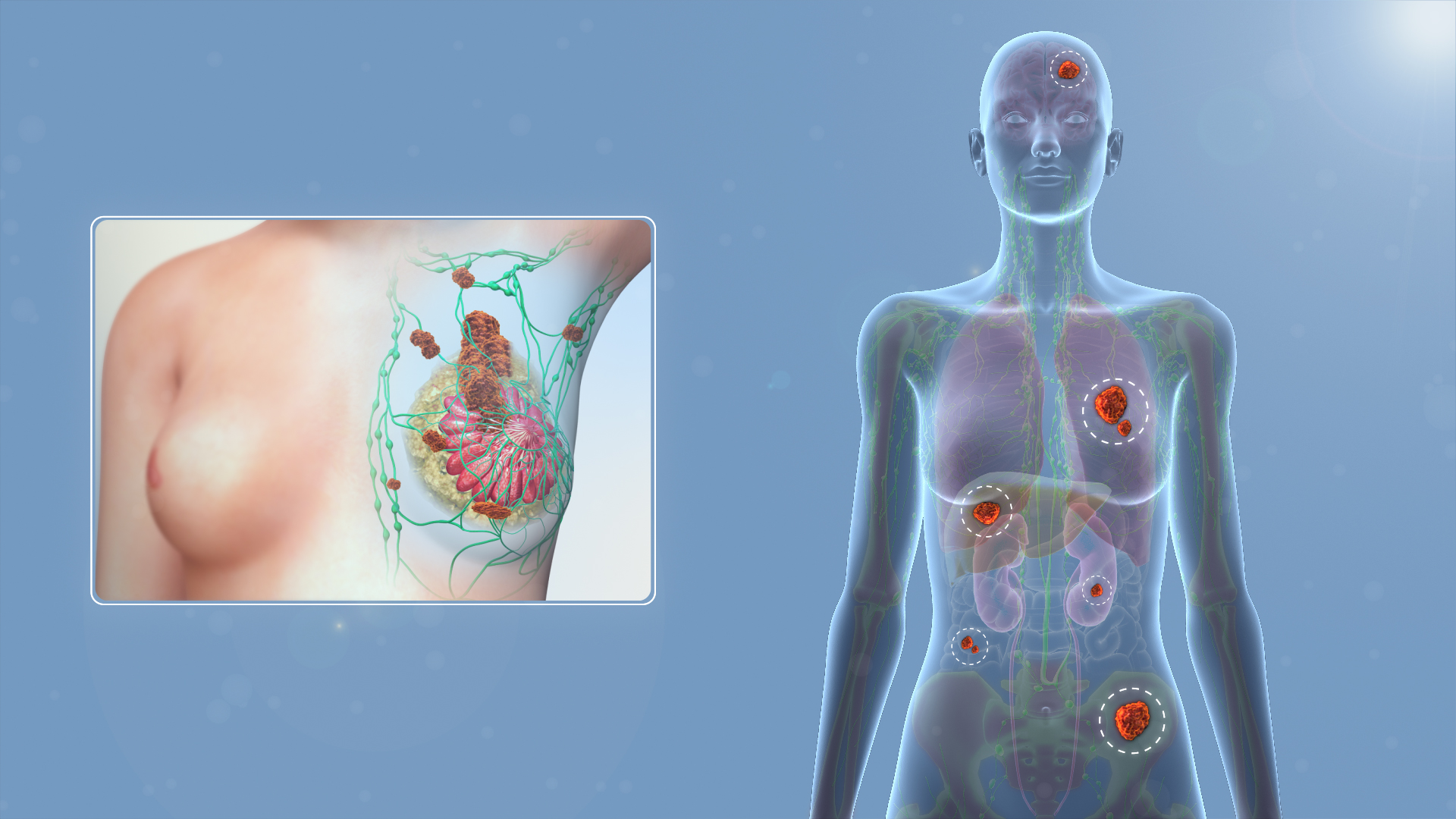 Stádium T4 s metastázemi v mízních uzlinách. (Kredit: www.scientificanimations.com . Zdroj: http://www.scientificanimations.com/wiki-images)