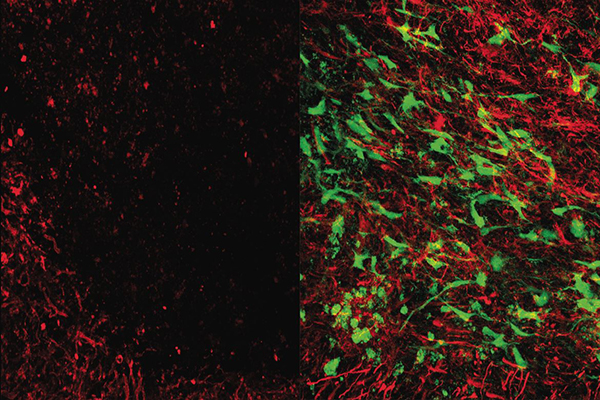 Mikroskopický snímek mrtvicí poškozené tkáně bílé hmoty mozku (vlevo). Vpravo je snímek stejně poškozené bílé hmoty jedince, který byl léčen aplikací gliových buněk. Dobře viditelné jsou rozdíly v přítomnosti myelinu (červeně). Myelin je látka, která