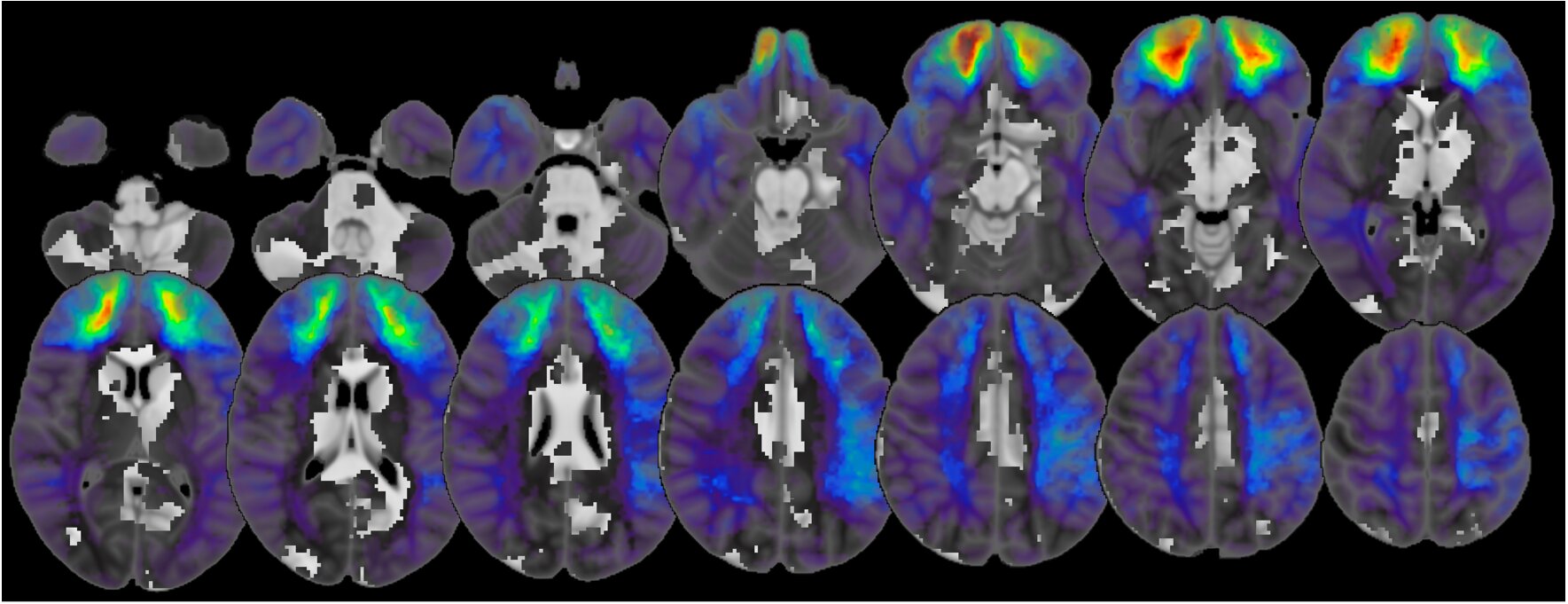 Mapování mozku. Kredit: Siddiqi et al. (2025), Brain.