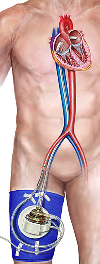 pVAD - zapojenie prĂ­stroja TandemHeart: krv je kanylou odoberanĂˇ do pumpy z Äľavej predsiene srdca a ÄŤerpanĂˇ do jednej alebo oboch stehennĂ˝ch tepien. (Kredit: TandemHeart, pVAD illustration CardiacAssist, Inc.)