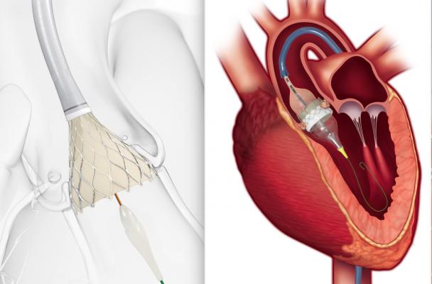 Zavedenie protézy aortálnej chlopne pomocou katétra (TAVR): nefunkčná zúžená aortálna chlopňa sa pomocou balónika 