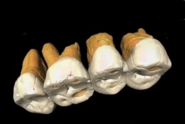 Zuby nového druhu člověka, který žil na Filipínách před 50 000 lety.  Kredit F. Détroit et al. Další obrázky zde. https://www.nationalgeographic.com/science/2019/04/new-species-ancient-human-discovered-luzon-philippines-homo-luzonensis/.