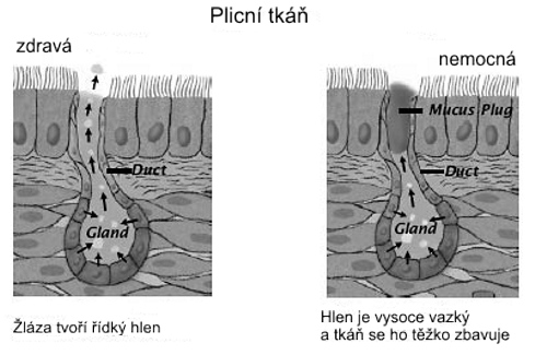 cystická fibróza